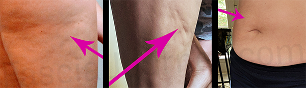 "FasciaBlaster for Cellulite" blog post feature image